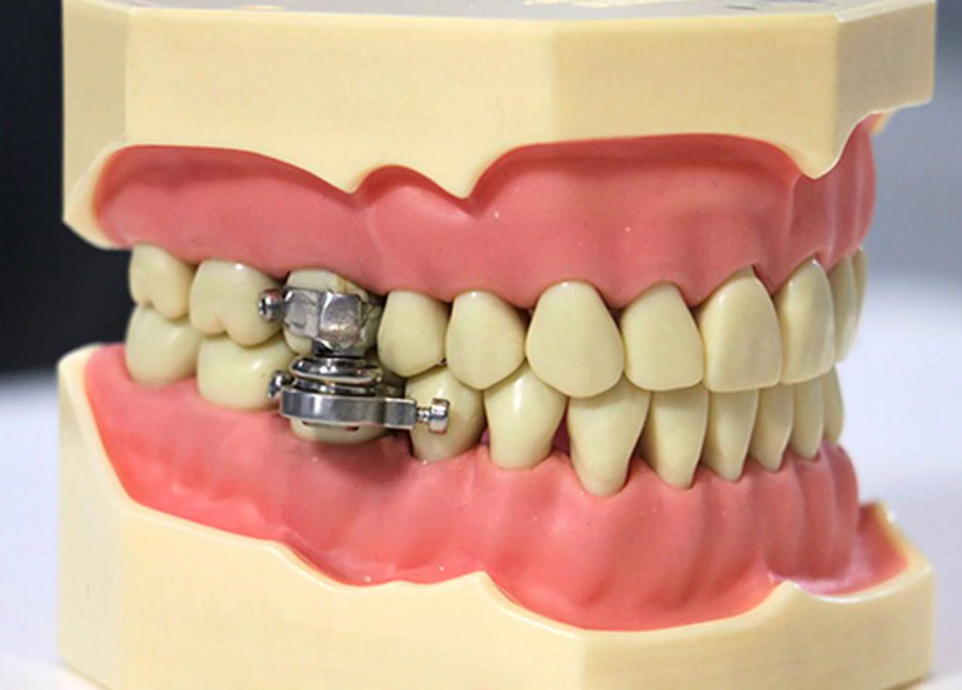 Dentadura